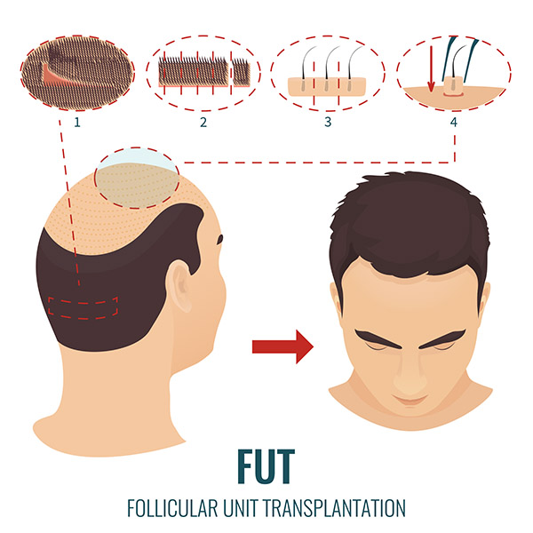 FUT Hair Transplant