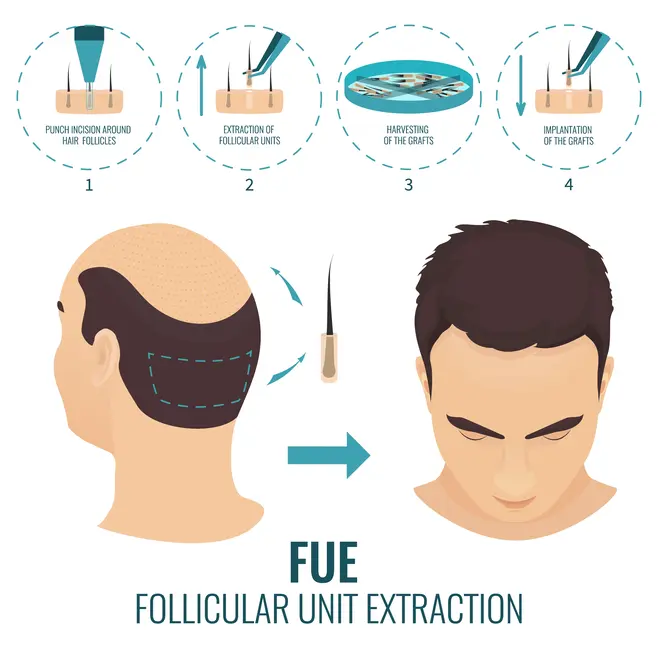 FUE Hair Transplant